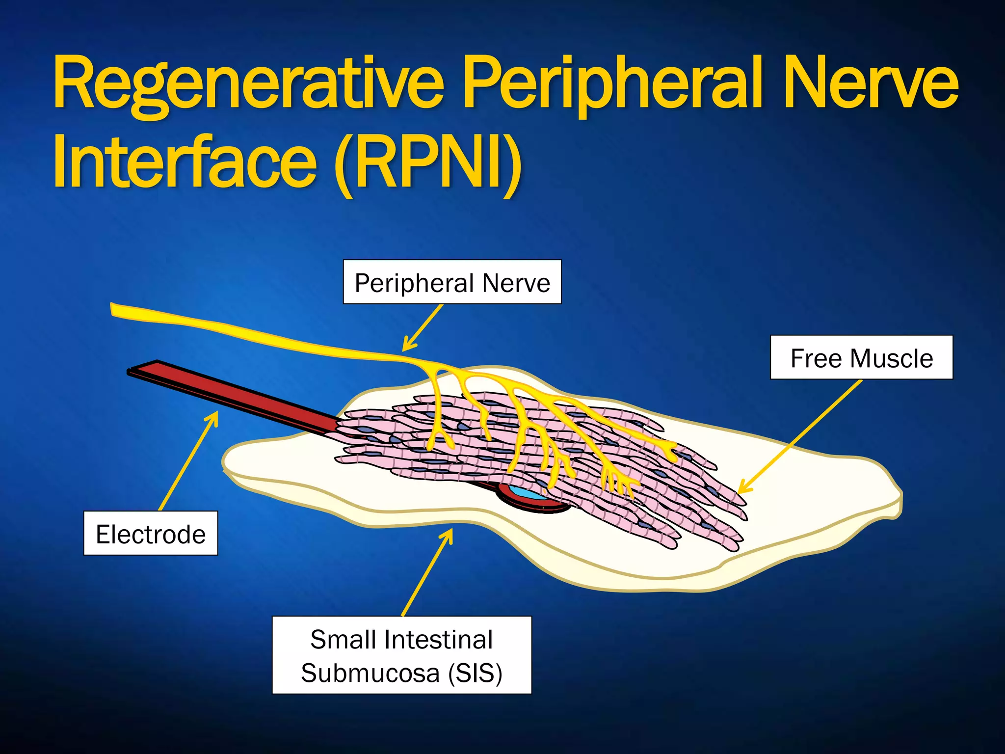 Regenerative Peripheral
Nerve Interface (RPNI)
Free Muscle
Peripheral
Nerve
Electrod
e
Small Intestinal
Submucosa (SIS)
 