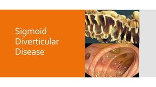 Sigmoid
Diverticular
Disease
 