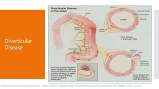 Diverticular
Disease
Simmang CL, Shires III GT. Diverticular disease of the colon. In: Feldman M, Friedman LS, Sleisinger MH, editors. Sleisinger & Fordtran’s gastrointestinal and liver disease. 7th ed. Philadephia: Saunders, 2002:2100-2.
 