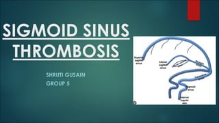 SIGMOID SINUS
THROMBOSIS
SHRUTI GUSAIN
GROUP 5
 