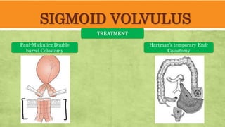 SIGMOID VOLVULUS
TREATMENT
Paul-Mickulicz Double
barrel Colostomy
Hartman’s temporary End-
Colostomy
 
