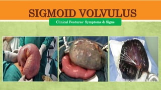 SIGMOID VOLVULUS
Clinical Features- Symptoms & Signs
 