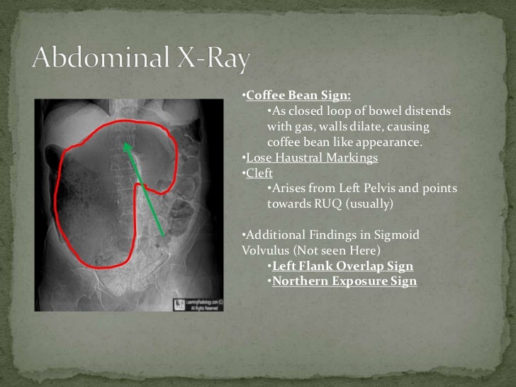 Sigmoid volvulus (2)
Volvulus X Ray Omega Sign