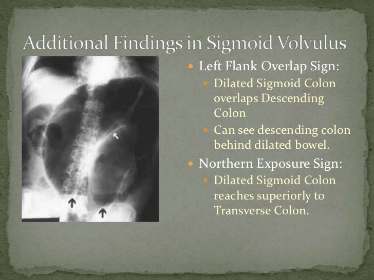 Sigmoid volvulus (2)
Volvulus X Ray Omega Sign