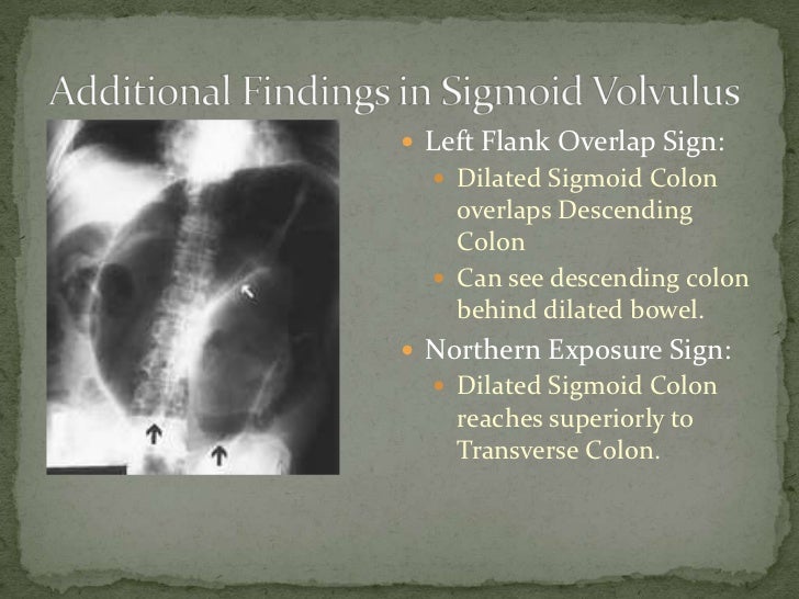 Sigmoid volvulus (2)