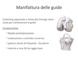 Manifattura delle guide Il planning approvato e rivisto dal chirurgo viene usato per confezionare le guide Caratteristiche Rapida prototipizzazione realizzazione a controllo numerico polvere sterile di Polyamid – Duraform indurita e resa 3D da raggio laser 