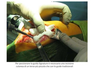 Per posizionare la guida Signature è necessaria una incisione cutanea di un terzo più piccola che con le guide tradizionali 