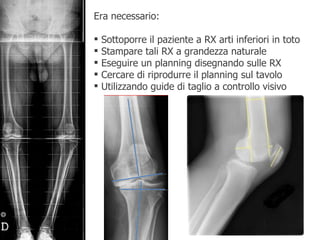 Era necessario: Sottoporre il paziente a RX arti inferiori in toto Stampare tali RX a grandezza naturale Eseguire un planning disegnando sulle RX Cercare di riprodurre il planning sul tavolo  Utilizzando guide di taglio a controllo visivo 