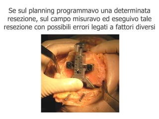 Se sul planning programmavo una determinata resezione, sul campo misuravo ed eseguivo tale resezione con possibili errori legati a fattori diversi 