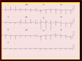 Significance of avR lead | PPTX