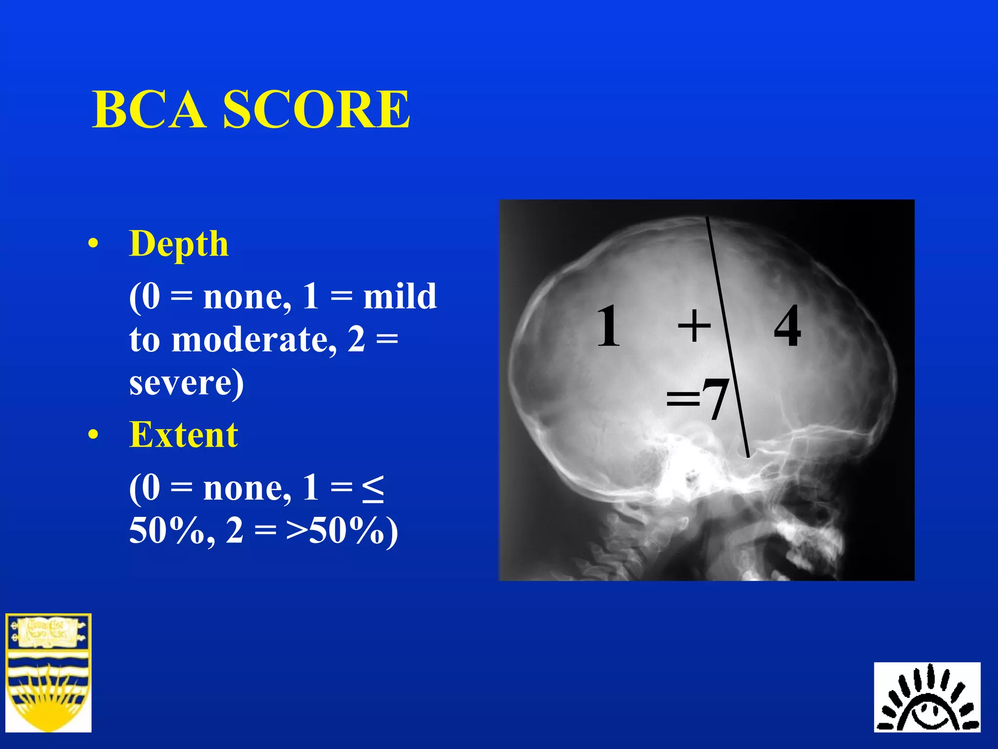 Significance of beaten copper appearance on skull radiographs in ...
