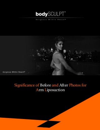 Significance of Before and After Photos for
Arm Liposuction
 