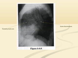 Corazón/aorta ascCorazón/aorta asc
Aorta descendenteAorta descendente
 