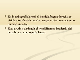  En la radiografía lateral, el hemidiafragma derecho esEn la radiografía lateral, el hemidiafragma derecho es
visible a través del corazón porque está en contacto convisible a través del corazón porque está en contacto con
pulmón aireado.pulmón aireado.
 Esto ayuda a distinguir el hemidifragma izquierdo delEsto ayuda a distinguir el hemidifragma izquierdo del
derecho en la radiografía lateralderecho en la radiografía lateral
 