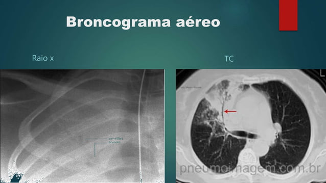 Signo del broncograma aereo
