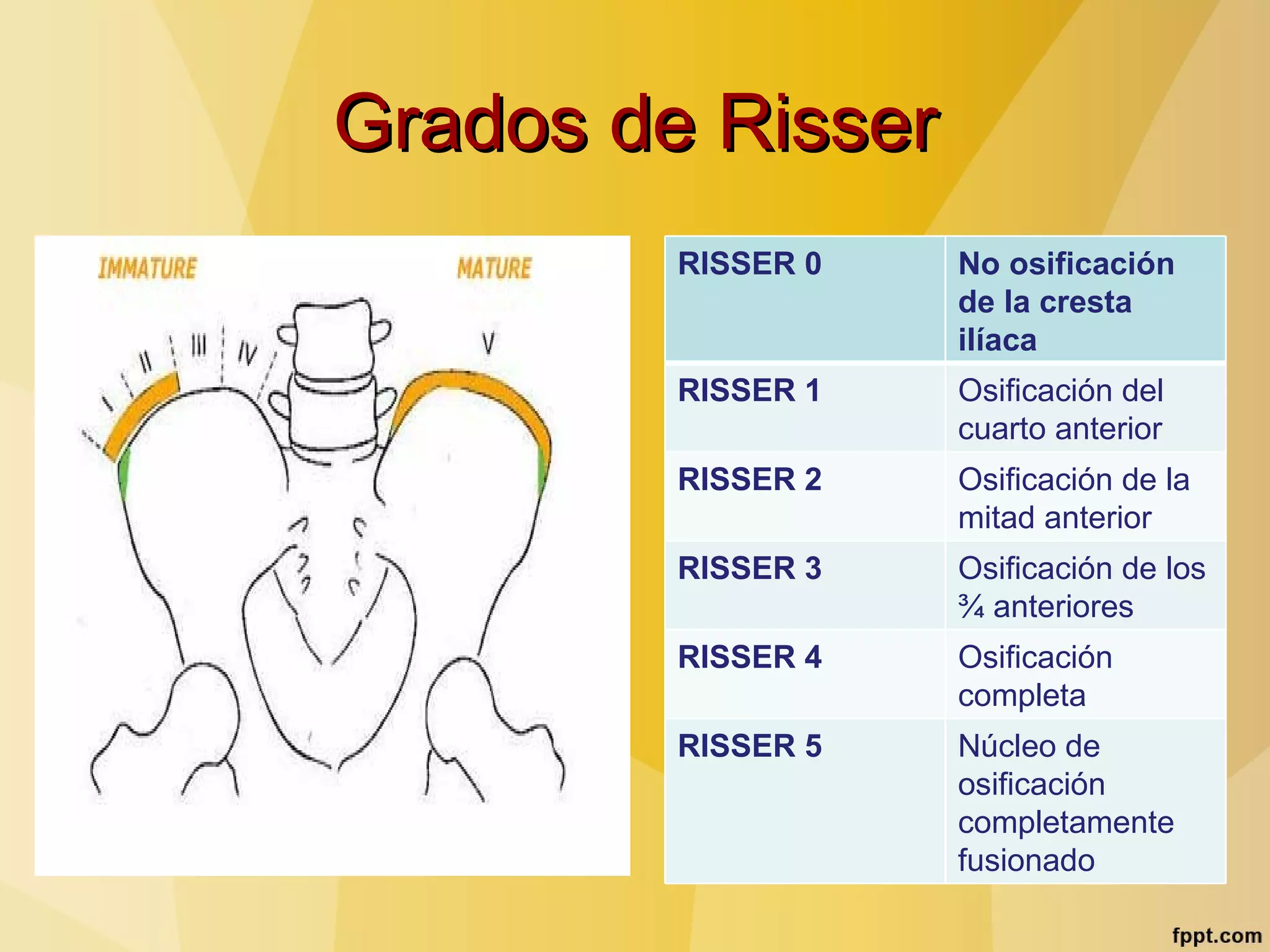 Signo de risser | PPT