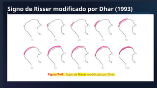 Evaluación del Signo de Risser y Madurez Esquelética en Escoliosis | PPTX