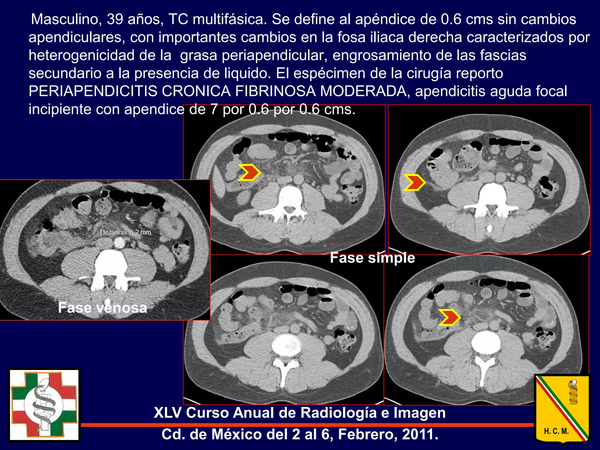 Signologia apendicitis aguda por TC | PDF