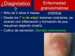 ¿Diagnóstico
?
• Niño de 2 años 4 meses
• Desde los 7 m de edad: lesiones nodulares, se
ulceran con inflamación y formación de pus,
resuelven dejando cicatriz
• Cultivo de secreción: Serratia marcescens
Enfermedad
granulomatosa
crónica
 
