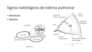 Signos radiológicos de edema pulmonar
• Intersticial
• Alveolar
 
