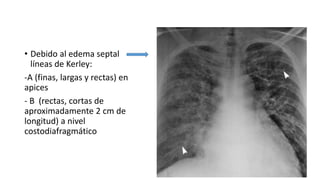 • Debido al edema septal
líneas de Kerley:
-A (finas, largas y rectas) en
apices
- B (rectas, cortas de
aproximadamente 2 cm de
longitud) a nivel
costodiafragmático
 