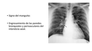 • Signo del manguito:
• Engrosamiento de las paredes
bronquiales y perivasculares del
intersticio axial.
 
