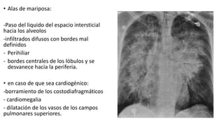 • Alas de mariposa:
-Paso del liquido del espacio intersticial
hacia los alveolos
-infiltrados difusos con bordes mal
definidos
- Perihiliar
- bordes centrales de los lóbulos y se
desvanece hacia la periferia.
• en caso de que sea cardiogénico:
-borramiento de los costodiafragmáticos
- cardiomegalia
- dilatación de los vasos de los campos
pulmonares superiores.
 