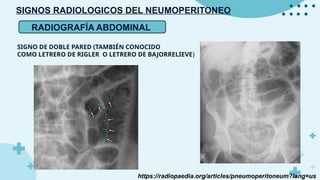 Sdinal De Rigler SIGNOS RADIOLOGICOS DEL NEUMOPERITONEO.pptx