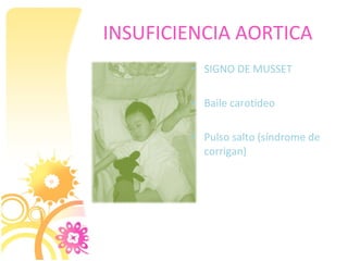 INSUFICIENCIA AORTICA
        • SIGNO DE MUSSET

        • Baile carotideo

        • Pulso salto (síndrome de
          corrigan)
 