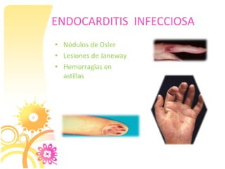 ENDOCARDITIS INFECCIOSA
• Nódulos de Osler
• Lesiones de Janeway
• Hemorragias en
  astillas
 