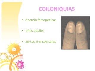 COILONIQUIAS
• Anemia ferropénicas

• Uñas débiles

• Surcos transversales
 