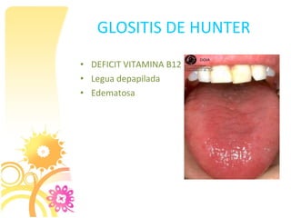 GLOSITIS DE HUNTER
• DEFICIT VITAMINA B12
• Legua depapilada
• Edematosa
 