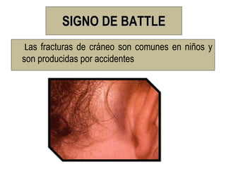 SIGNO DE BATTLE
 Las fracturas de cráneo son comunes en niños y
son producidas por accidentes
 