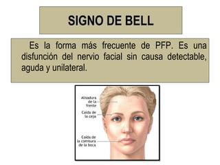 SIGNO DE BELL
  Es la forma más frecuente de PFP. Es una
disfunción del nervio facial sin causa detectable,
aguda y unilateral.
 