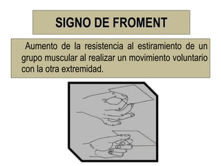 SIGNO DE FROMENT
 Aumento de la resistencia al estiramiento de un
grupo muscular al realizar un movimiento voluntario
con la otra extremidad.
 