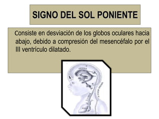 SIGNO DEL SOL PONIENTE
Consiste en desviación de los globos oculares hacia
abajo, debido a compresión del mesencéfalo por el
III ventrículo dilatado.
 