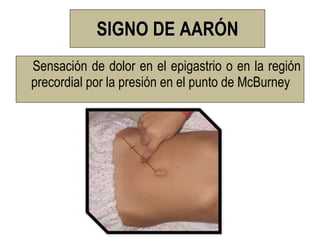 SIGNO DE AARÓN
Sensación de dolor en el epigastrio o en la región
precordial por la presión en el punto de McBurney
 