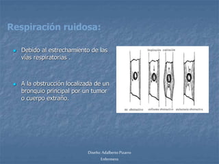 Respiración ruidosa: 
 Debido al estrechamiento de las 
vías respiratorias . 
 A la obstrucción localizada de un 
bronquio principal por un tumor 
o cuerpo extraño. 
Diseño: Adalberto Pizarro 
Enfermero 
 