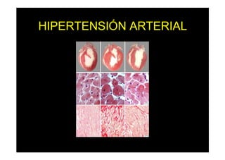 HIPERTENSIÓN ARTERIAL
 