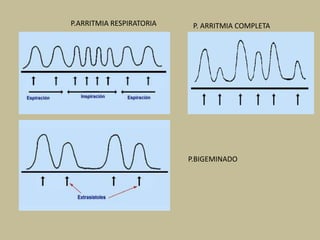 P.ARRITMIA RESPIRATORIA P. ARRITMIA COMPLETA
P.BIGEMINADO
 