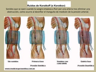Sonidos que se oyen cuando la sangre empieza a fluir por una arteria tras eliminar una
obstrucción, como ocurre al desinflar el manguito de medicón de la presión arterial.
Ruidos de Korotkoff (o Korotkov)
 