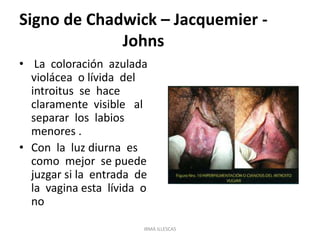 Signo de Chadwick – Jacquemier -
Johns
• La coloración azulada
violácea o lívida del
introitus se hace
claramente visible al
separar los labios
menores .
• Con la luz diurna es
como mejor se puede
juzgar si la entrada de
la vagina esta lívida o
no
IRMA ILLESCAS
 