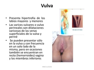 Vulva
• Presenta hipertrofia de los
labios mayores y menores
• Las varices vulvares o vulvo
perineales son dilataciones
varicosas de las venas
superficiales de la vulva y
periné
• Se pueden presentar sólo
en la vulva y con frecuencia
en un solo lado de la
misma, pero en ocasiones
también se encuentran en
recto (hemorroides) vagina
y los miembros inferiores
IRMA ILLESCAS
 