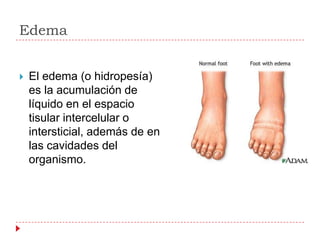 Edema


   El edema (o hidropesía)
    es la acumulación de
    líquido en el espacio
    tisular intercelular o
    intersticial, además de en
    las cavidades del
    organismo.
 