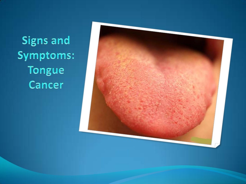 Signs And Symptoms Tongue Cancer Signs And Symptoms Tongue Cancer