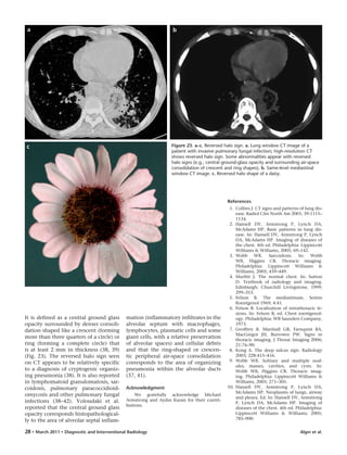 Algın et al.28 • March 2011 • Diagnostic and Interventional Radiology
It is defined as a central ground glass
opacity surrounded by denser consoli-
dation shaped like a crescent (forming
more than three quarters of a circle) or
ring (forming a complete circle) that
is at least 2 mm in thickness (38, 39)
(Fig. 23). The reversed halo sign seen
on CT appears to be relatively specific
to a diagnosis of cryptogenic organiz-
ing pneumonia (38). It is also reported
in lymphomatoid granulomatosis, sar-
coidosis, pulmonary paracoccidioid-
omycosis and other pulmonary fungal
infections (38–42). Voloudaki et al.
reported that the central ground glass
opacity corresponds histopathological-
ly to the area of alveolar septal inflam-
mation (inflammatory infiltrates in the
alveolar septum with macrophages,
lymphocytes, plasmatic cells and some
giant cells, with a relative preservation
of alveolar spaces) and cellular debris
and that the ring-shaped or crescen-
tic peripheral air-space consolidation
corresponds to the area of organizing
pneumonia within the alveolar ducts
(37, 41).
Acknowledgment
We gratefully acknowledge Michael
Armstrong and Aydın Kuran for their contri-
butions.
References
1. Collins J. CT signs and patterns of lung dis-
ease. Radiol Clin North Am 2001; 39:1115–
1134.
2. Hansell DV, Armstrong P, Lynch DA,
McAdams HP. Basic patterns in lung dis-
ease. In: Hansell DV, Armstrong P, Lynch
DA, McAdams HP. Imaging of diseases of
the chest. 4th ed. Philadelphia: Lippincott
Williams & Williams, 2005; 69–142.
3. Webb WR. Sarcoidosis. In: Webb
WR, Higgins CB. Thoracic imaging.
Philadelphia: Lippincott Williams &
Williams, 2005; 439–449.
4. Murfitt J. The normal chest. In: Sutton
D. Textbook of radiology and imaging.
Edinburgh: Churchill Livingstone, 1999;
299–353.
5. Felson B. The mediastinum. Semin
Roentgenol 1969; 4:41.
6. Felson B. Localization of intrathoracic le-
sions. In: Felson B, ed. Chest roentgenol-
ogy. Philadelphia: WB Saunders Company,
1973.
7. Geoffrey B. Marshall GB, Farnquist BA,
MacGregor JH, Burrowes PW. Signs in
thoracic imaging. J Thorac Imaging 2006;
21:76–90.
8. Kong A. The deep sulcus sign. Radiology
2003; 228:415–416.
9. Webb WR. Solitary and multiple nod-
ules, masses, cavities, and cysts. In:
Webb WR, Higgins CB. Thoracic imag-
ing. Philadelphia: Lippincott Williams &
Williams, 2005; 271–305.
10. Hansell DV, Armstrong P, Lynch DA,
McAdams HP. Neoplasms of lungs, airway
and pleura. Ed. In: Hansell DV, Armstrong
P, Lynch DA, McAdams HP. Imaging of
diseases of the chest. 4th ed. Philadelphia:
Lippincott Williams & Williams; 2005;
785–900.
Figure 23. a–c. Reversed halo sign. a. Lung window CT image of a
patient with invasive pulmonary fungal infection; high-resolution CT
shows reversed halo sign. Some abnormalities appear with reversed
halo signs (e.g., central ground-glass opacity and surrounding air-space
consolidation of crescent and ring shapes). b. Same-level mediastinal
window CT image. c. Reversed halo shape of a daisy.
ba
c
 