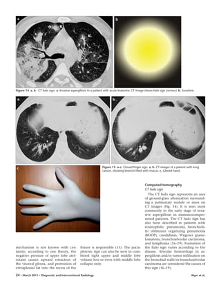 Algın et al.24 • March 2011 • Diagnostic and Interventional Radiology
mechanism is not known with cer-
tainty; according to one theory, the
negative pressure of upper lobe atel-
ectasis causes upward retraction of
the visceral pleura, and protrusion of
extrapleural fat into the recess of the
fissure is responsible (15). The juxta-
phrenic sign can also be seen in com-
bined right upper and middle lobe
volume loss or even with middle lobe
collapse only.
Computed tomography
CT halo sign
The CT halo sign represents an area
of ground-glass attenuation surround-
ing a pulmonary nodule or mass on
CT images (Fig. 14). It is seen most
commonly in the early stage of inva-
sive aspergillosis in immunocompro-
mised patients. The CT halo sign has
also been described in patients with
eosinophilic pneumonia, bronchioli-
tis obliterans organizing pneumonia
(BOOP), candidiasis, Wegener granu-
lomatosis, bronchoalveolar carcinoma,
and lymphoma (16–19). Formation of
the halo sign varies according to the
disease. Alveolar hemorrhage in as-
pergillosis and/or tumor infiltration on
the bronchial walls in bronchoalveolar
carcinoma are considered the causes of
this sign (16–19).
Figure 14. a, b. CT halo sign. a. Invasive aspergillosis in a patient with acute leukemia: CT image shows halo sign (arrows). b. Sunshine.
ba
Figure 15. a–c. Gloved finger sign. a, b. CT images of a patient with lung
cancer, showing bronchi filled with mucus. c. Gloved hand.
ba
c
 