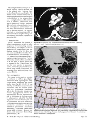Algın et al.26 • March 2011 • Diagnostic and Interventional Radiology
Adjacent pleural thickening is an es-
sential finding. There is volume loss
in the affected lobe. However, there
are two hypotheses regarding the for-
mation of the rounded atelectasis: an
underlying pleural effusion that causes
local atelectasis in the adjacent lung
and a local pleuritis caused by irritants
such as asbestos, tuberculosis, non-
specific pleuritis or Dressler syndrome
(23). As in the other atelectasis types,
the homogeneous enhancement oc-
curs after the intravenous administra-
tion of contrast material. The rounded
atelectasis is sometimes impossible to
differentiate from peripheral lung can-
cer. Biopsy is indicated in cases that are
equivocal (23).
CT angiogram sign
The CT angiogram sign consists of
enhancing pulmonary vessels in a ho-
mogeneous low-attenuating consoli-
dation of lung parenchyma relative to
the chest wall musculature at the me-
diastinal window (Fig. 18). This sign
has been described in the lobar form
of bronchoalveolar cell carcinoma (17,
24). Another important cause of the CT
angiogram sign is pneumonia. The low-
attenuating area has been considered
to be the result of mucus production
by tumor cells. The CT angiogram sign
has also been reported in pulmonary
edema, obstructive pneumonitis due to
central lung tumors, lymphoma, and
metastasis from gastrointestinal carci-
nomas (25, 26).
Crazy paving pattern
The crazy paving pattern consists
of scattered or diffuse ground-glass
attenuation with superimposed inter-
lobular septal thickening and intral-
obular lines (Fig. 19) (27–29). It was
initially described in cases of alveolar
proteinosis (30). In alveolar protei-
nosis, the ground-glass attenuation
reflects the low-density intraalveolar
material (glycoprotein), whereas the
superimposed reticular attenuation is
due to infiltration of the interstitium
by inflammatory cells (29). This find-
ing can be caused by Pneumocystis cari-
nii pneumonia, mucinous bronchoal-
veolar carcinoma, pulmonary alveolar
proteinosis, sarcoidosis, nonspecific
interstitial pneumonia, organizing
pneumonia, exogenous lipoid pneu-
monia, adult respiratory distress syn-
drome, and pulmonary hemorrhage
syndromes (27, 28).
Figure 18. CT angiogram sign. A patient with bronchoalveolar carcinoma. Enhancing
pulmonary vessels in a low-attenuating mass are seen.
Figure 19. a, b. Crazy paving pattern. a. Patient with situs inversus and Kartagener syndrome
showing diffuse ground-glass attenuation with superimposed interlobular septal thickening and
intralobular lines in both lungs. The cause of diffuse parenchymal disease in this patient was
alveolar proteinosis. b. Paving stones.
b
a
 
