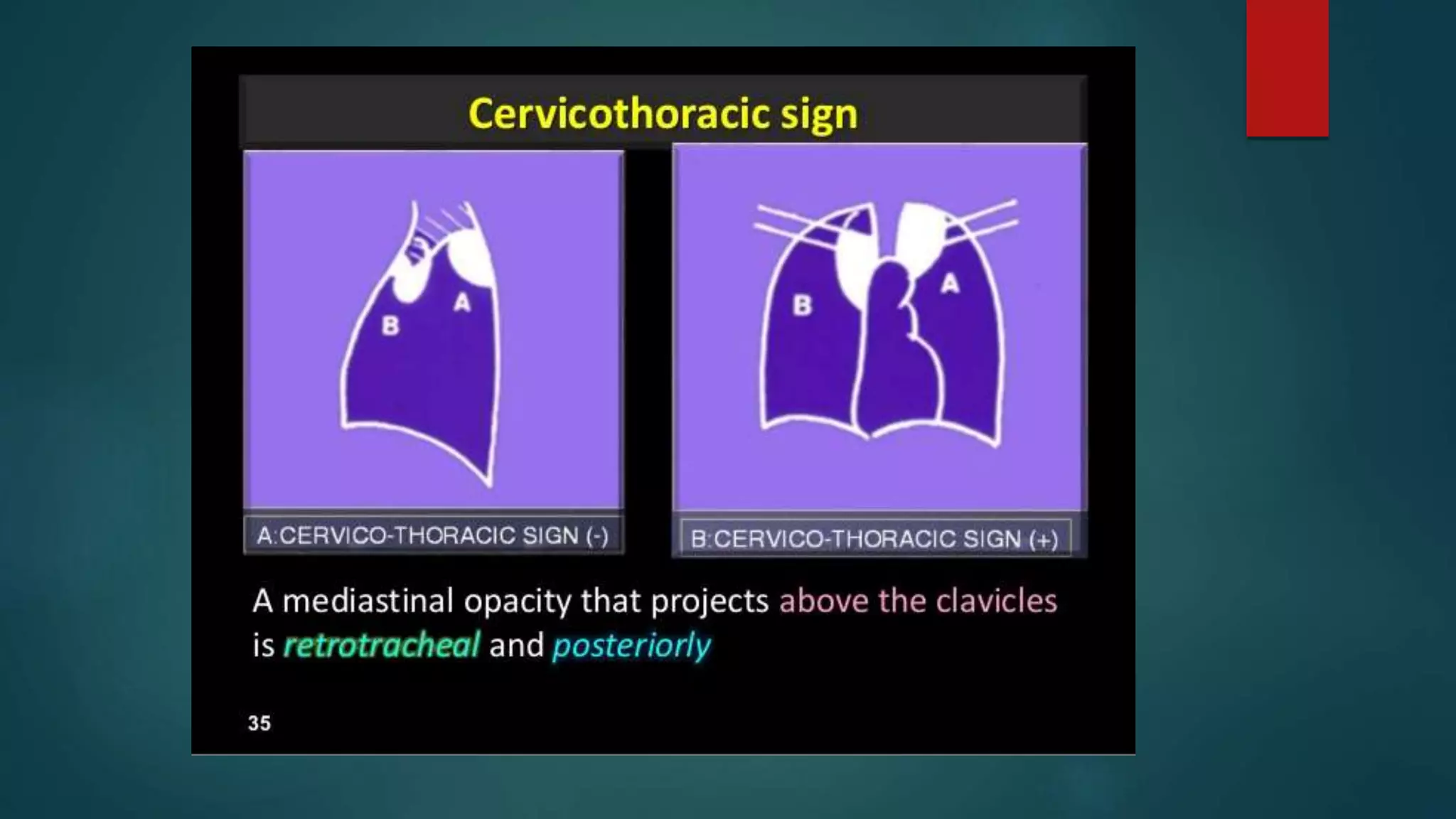 Stuart Sign Cervical Signs in chest xray | PPTX
