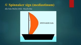Spinacker Sign Signs in chest xray | PPTX
